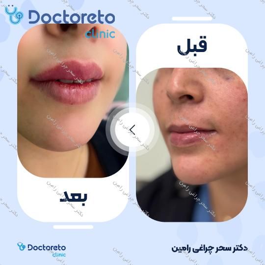 تزریق ژل لب