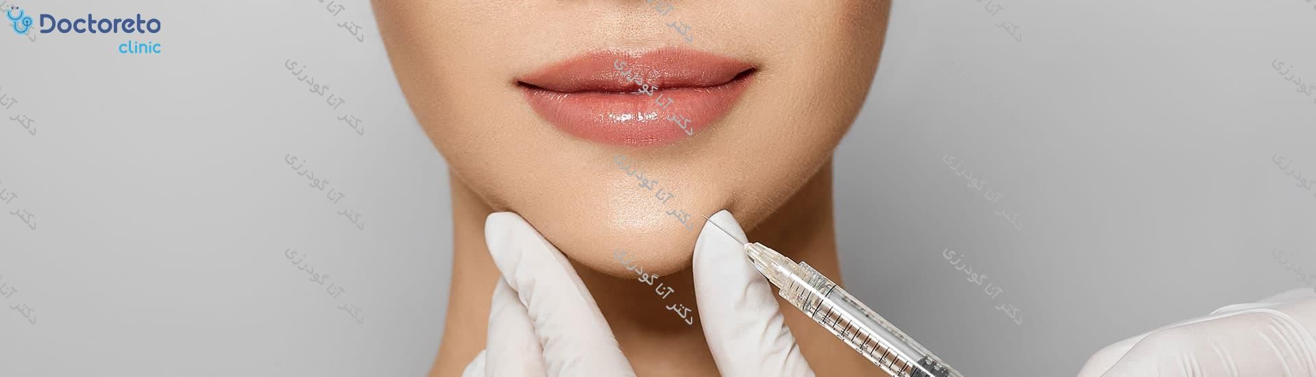 تزریق ژل چانه