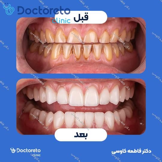 ایمپلنت دندان با روکش