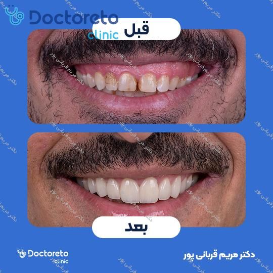 جرم گیری دندان با بروساژ🦷