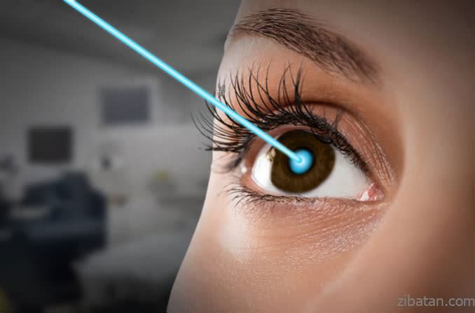 عمل جراحی حذف عینک به روش PRK