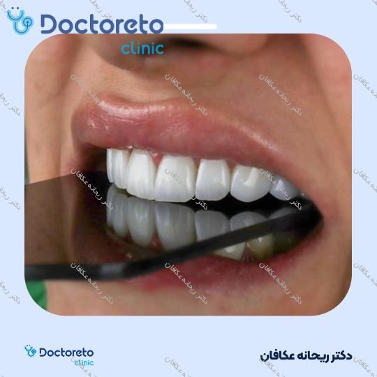 جرم گیری دندان با بروساژ🦷