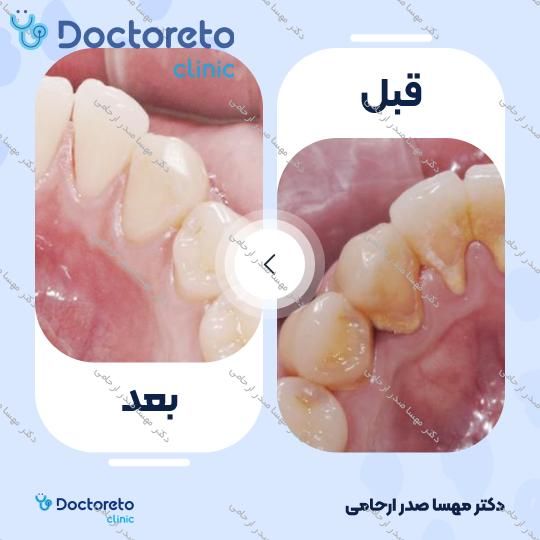 جرم گیری دندان با بروساژ🦷