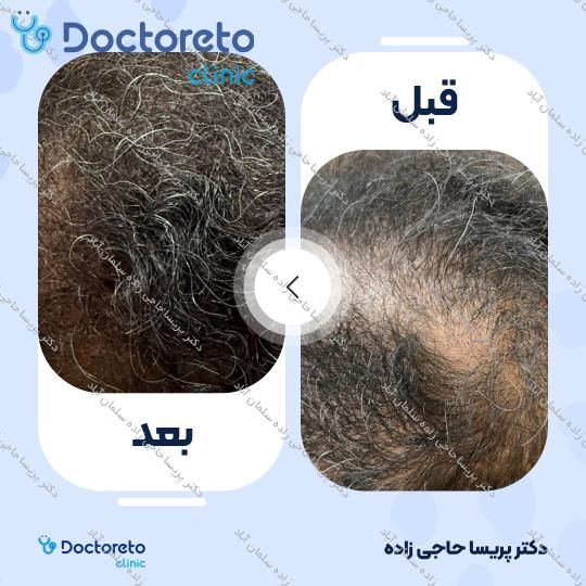 پلاسما تراپی مو (هر جلسه)
