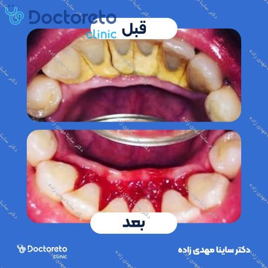 جرم گیری دندان با بروساژ🦷