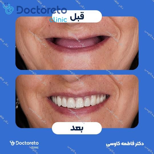 جراحی پیوند استخوان (هر واحد)