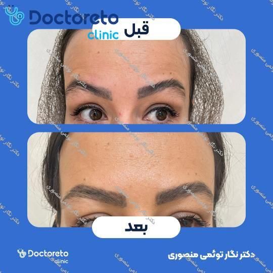 تزریق بوتاکس صورت