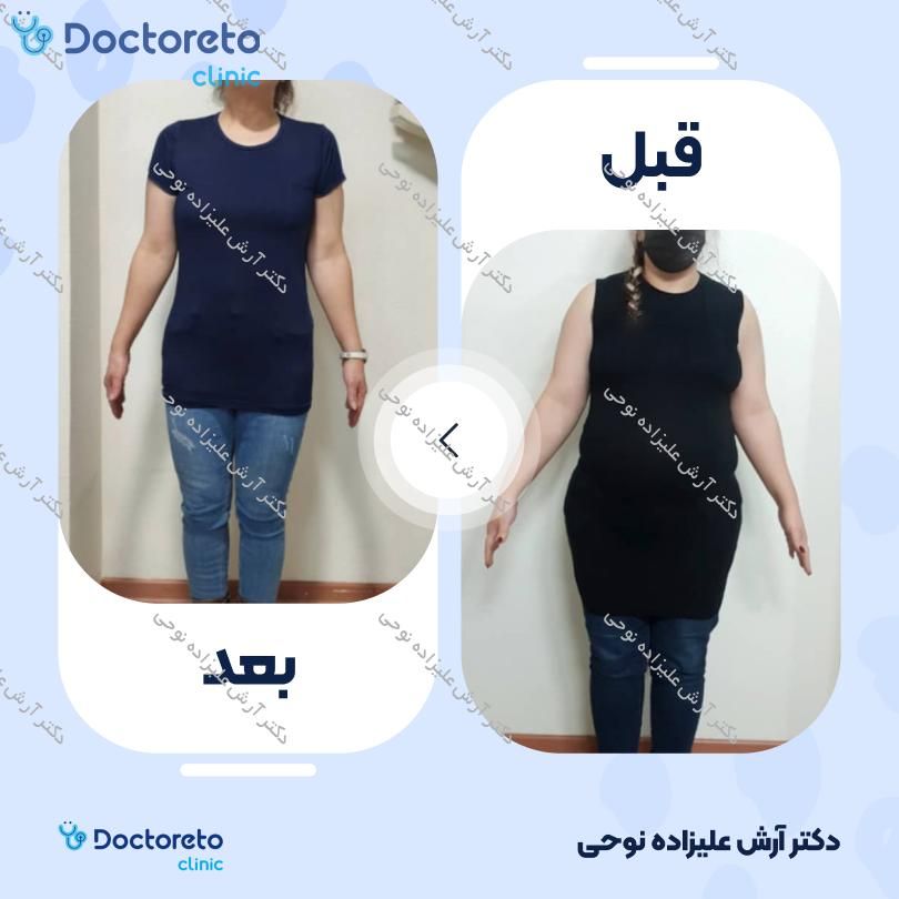 لاغری موضعی با دستگاه کویتیشن، به همراه و رژیم لاغری