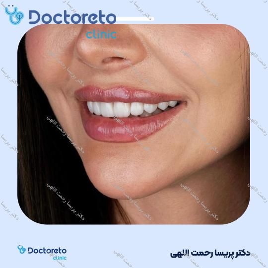لمینت سرامیکی ایمکس آمریکایی (هر واحد)