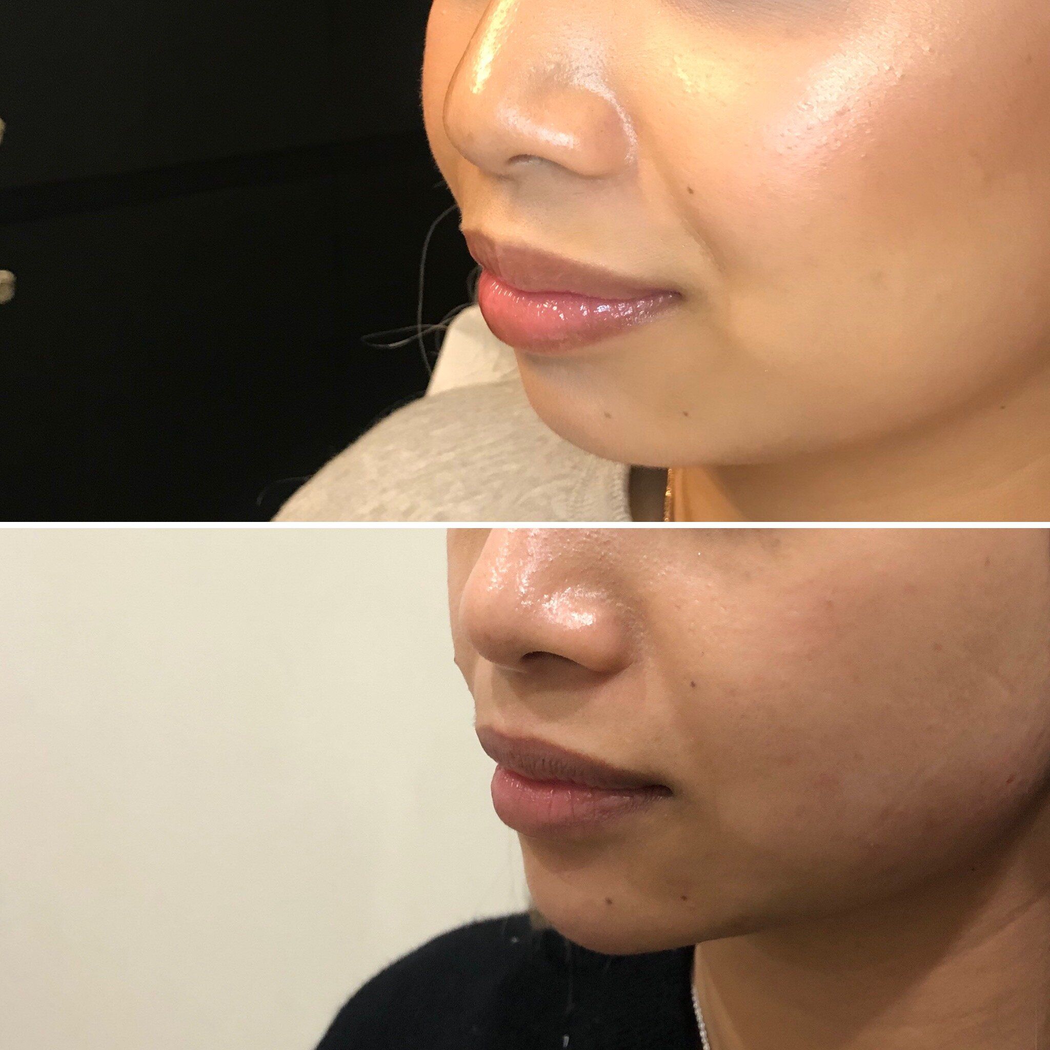 تزریق ژل چانه