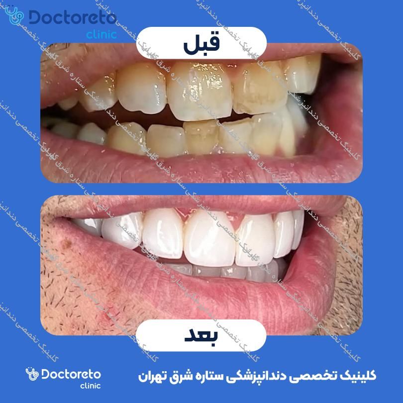 روکش دندان (هر واحد)