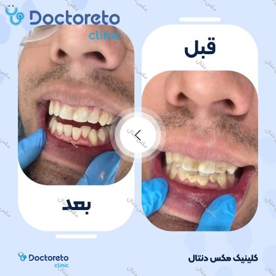 جرم گیری دندان با بروساژ🦷