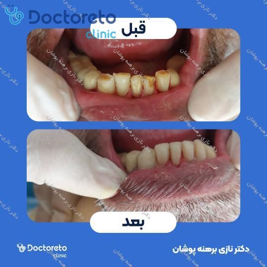 جرم گیری دندان با بروساژ🦷