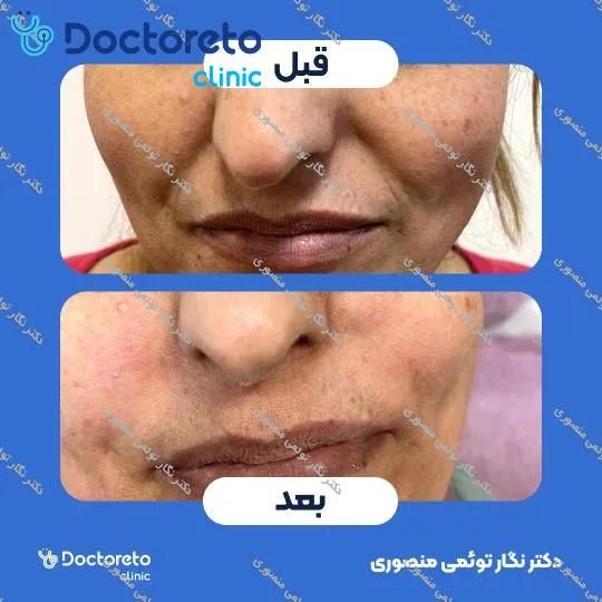 تزریق ژل خط خنده