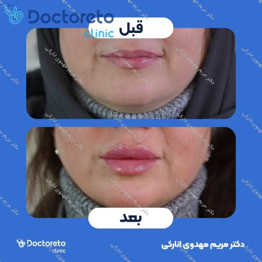 تزریق ژل لب