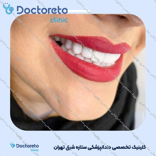 روکش دندان (هر واحد)