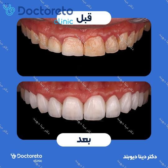 لمینت دندان (هر واحد)