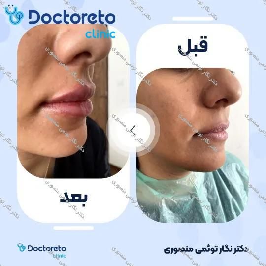 تزریق ژل لب