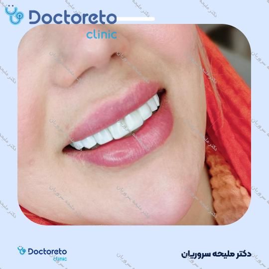 ونیر کامپوزیت (هر واحد)