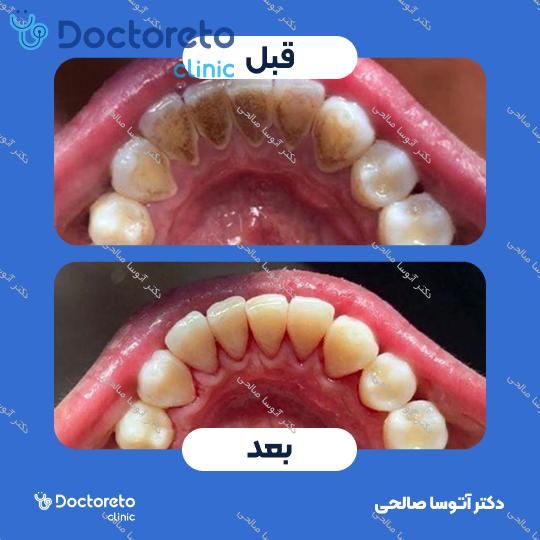 جرم گیری دندان با بروساژ🦷