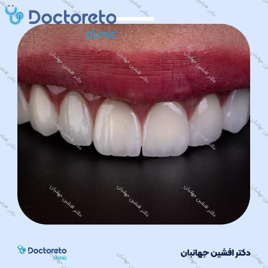 روکش دندان (هر واحد)