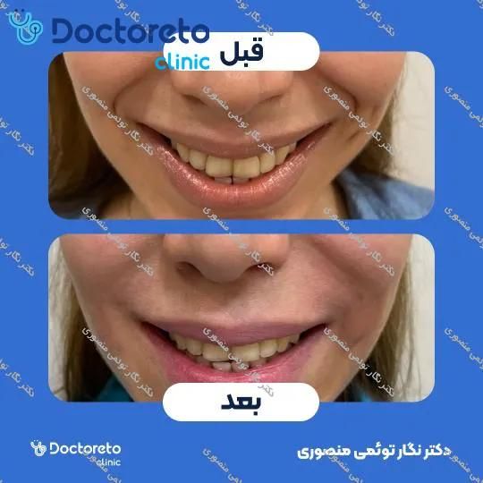 تزریق ژل خط خنده