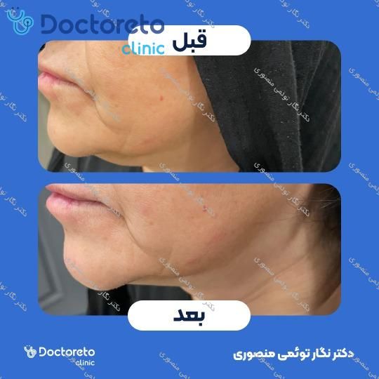 هایفوتراپی