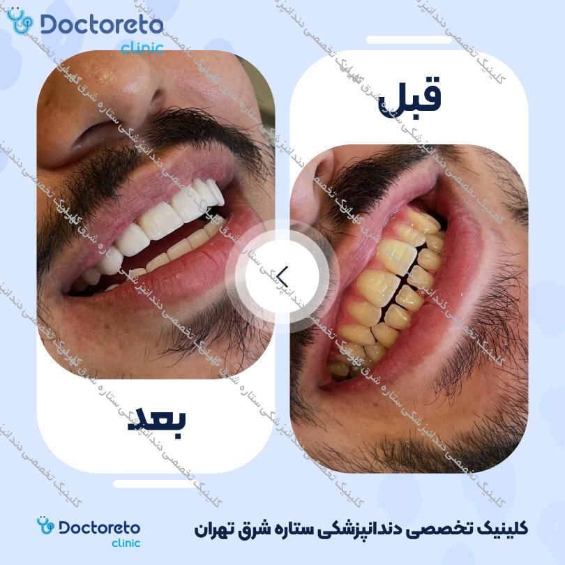 روکش دندان (هر واحد)