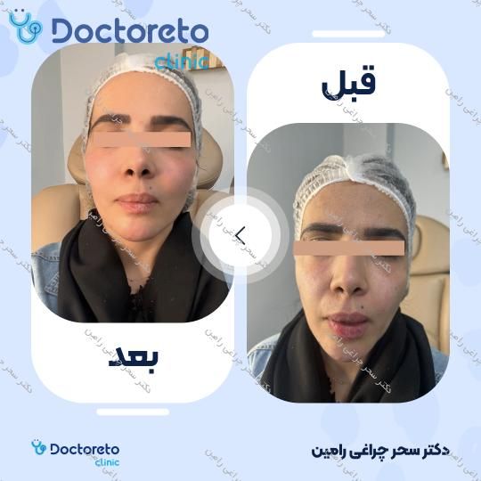 تزریق ژل چانه