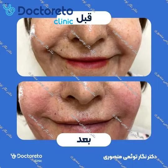 تزریق ژل خط خنده