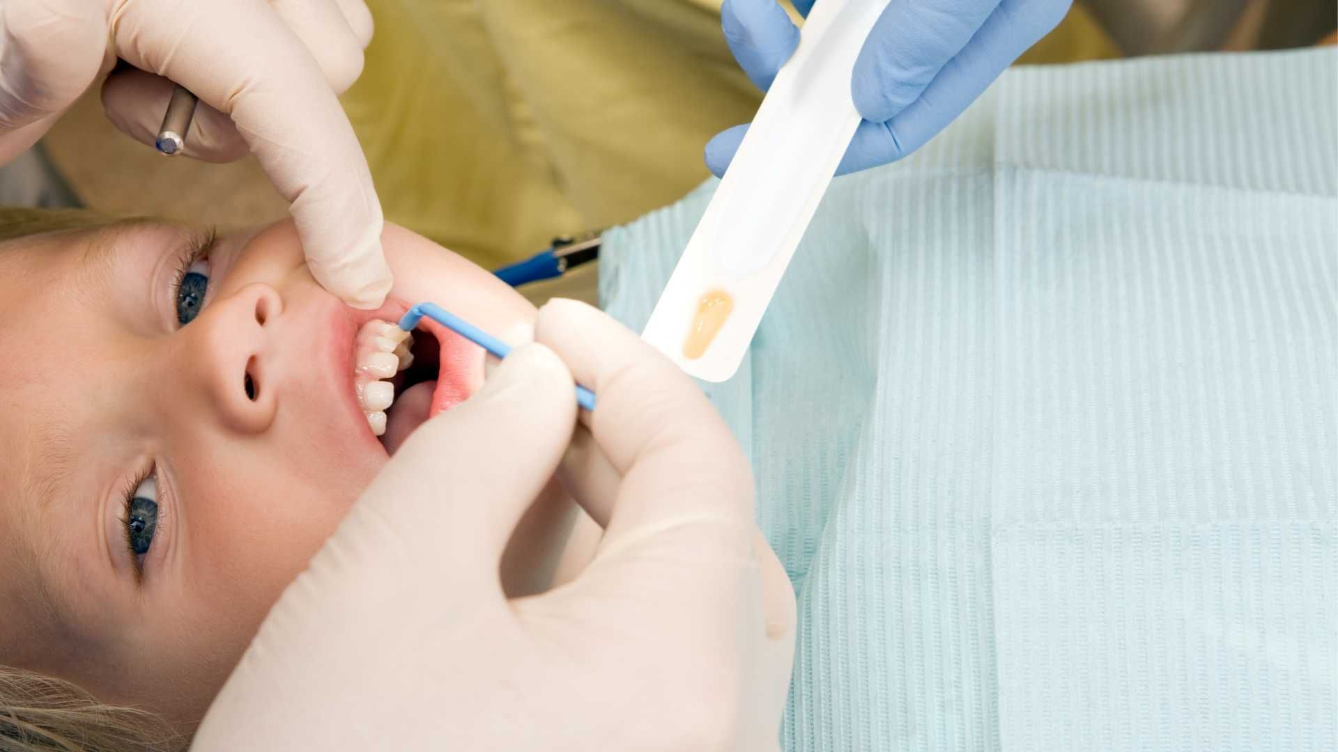 پر کردن دندان اطفال