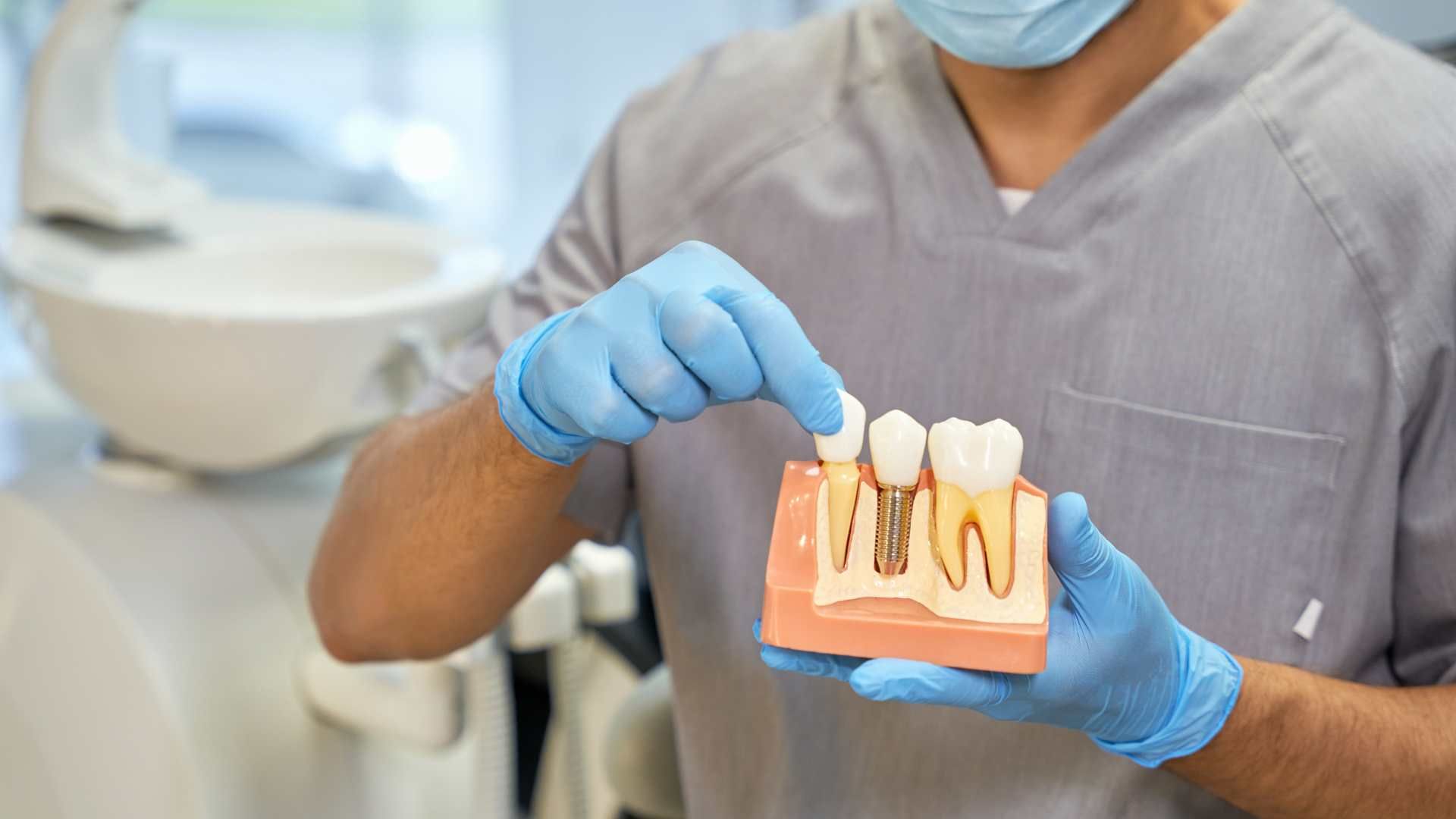 ایمپلنت دندان با روکش (هر واحد)