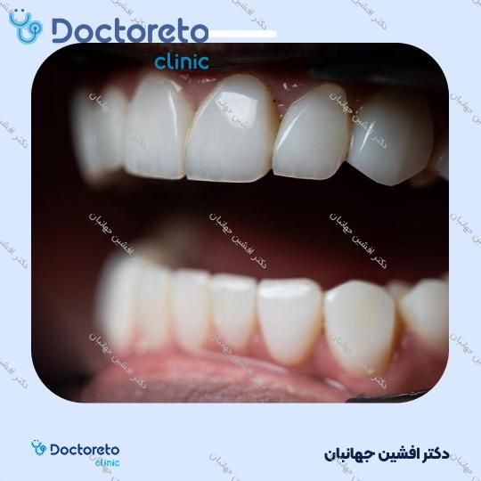 روکش دندان (هر واحد)