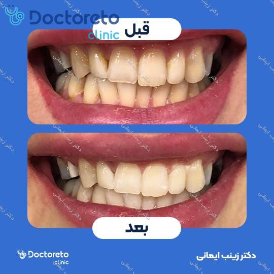 جرم گیری دندان با بروساژ🦷