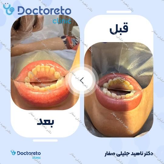 جرم گیری دندان با بروساژ🦷