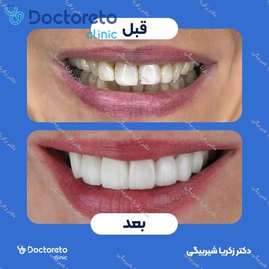 ونیر کامپوزیت (هر واحد)