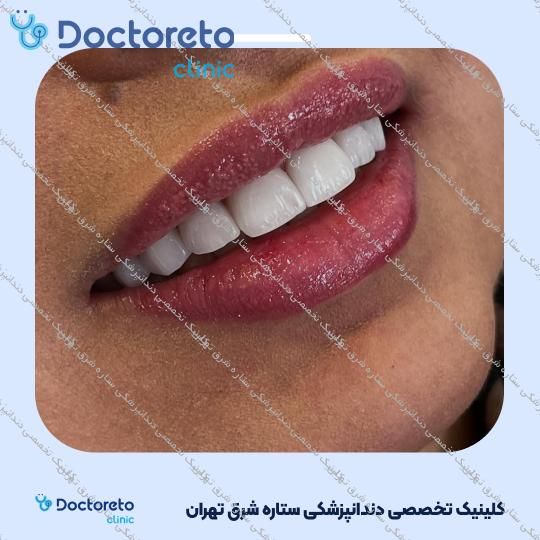 روکش دندان (هر واحد)