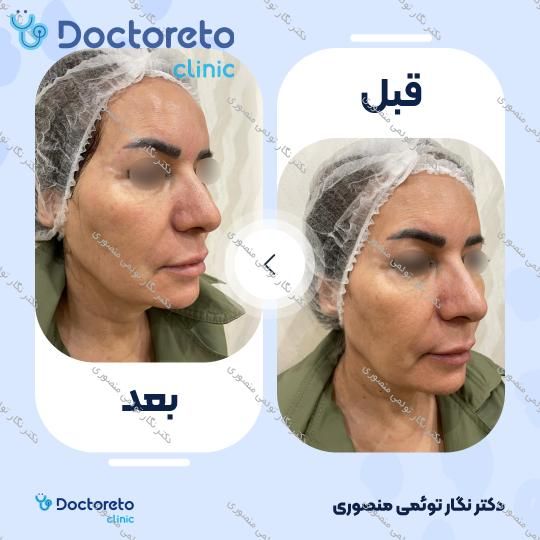 هایفوتراپی