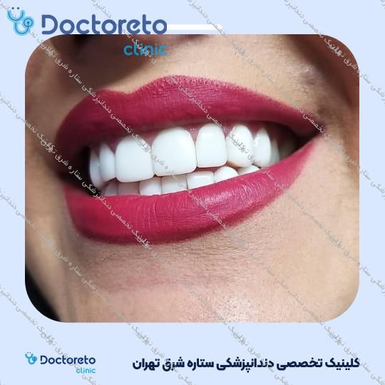 پر کردن دندان