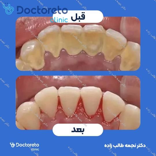 جرم گیری دندان با بروساژ🦷