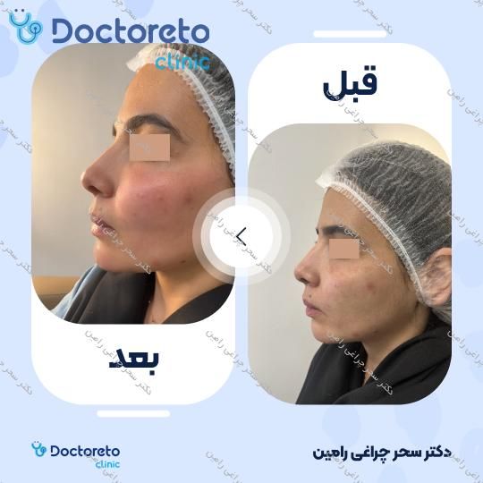 تزریق ژل چانه