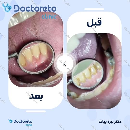 جرم گیری دندان با بروساژ🦷