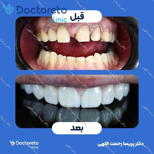 لمینت سرامیکی ایمکس آمریکایی (هر واحد)