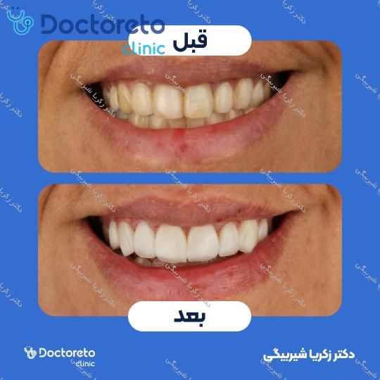 ونیر کامپوزیت (هر واحد)