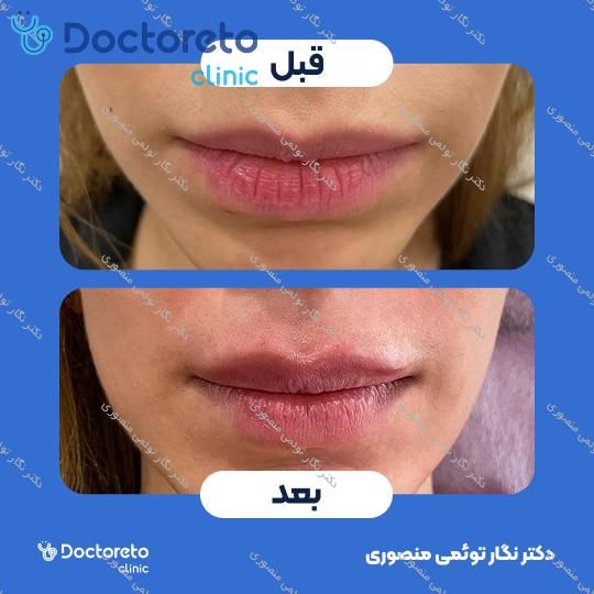 تزریق ژل لب با برند نورامیس (1CC)
