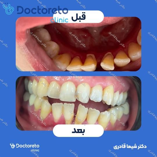 جرم گیری دندان با بروساژ 🦷