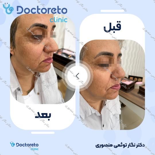 هایفوتراپی