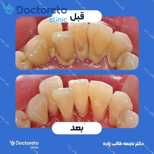 جرم گیری دندان با بروساژ🦷