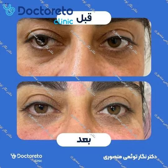 تزریق ژل زیر چشم