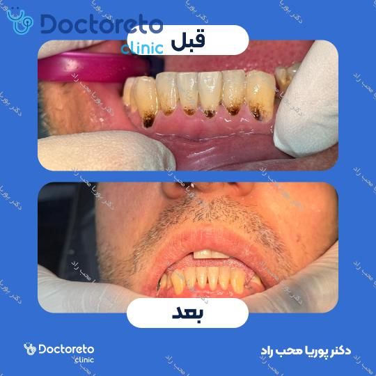 جرم گیری دندان با بروساژ🦷